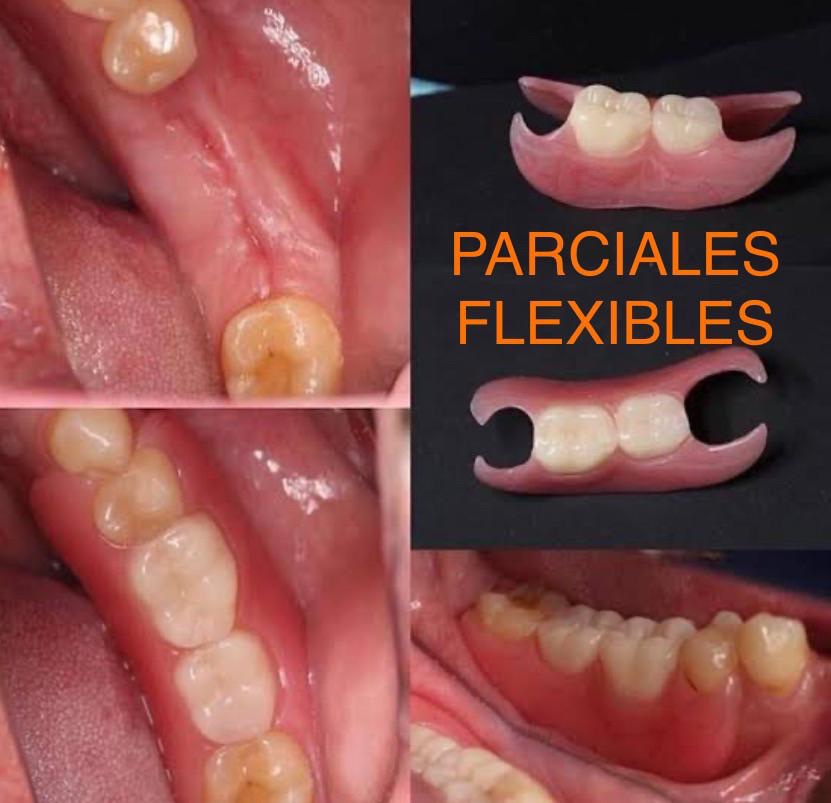 Servicio de parciales flexibles